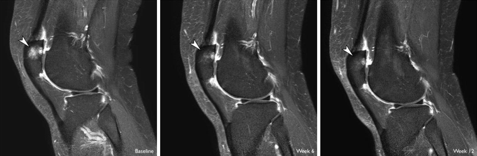 Sagittal image of a patellar bone marrow lesion