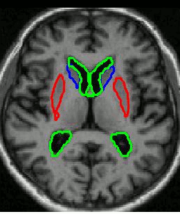 Image of an axial slice through the brain showing segmentaions of some subcortical structures