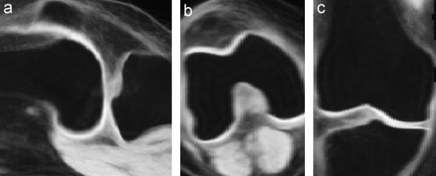 Mean knee image from group-wise registration method