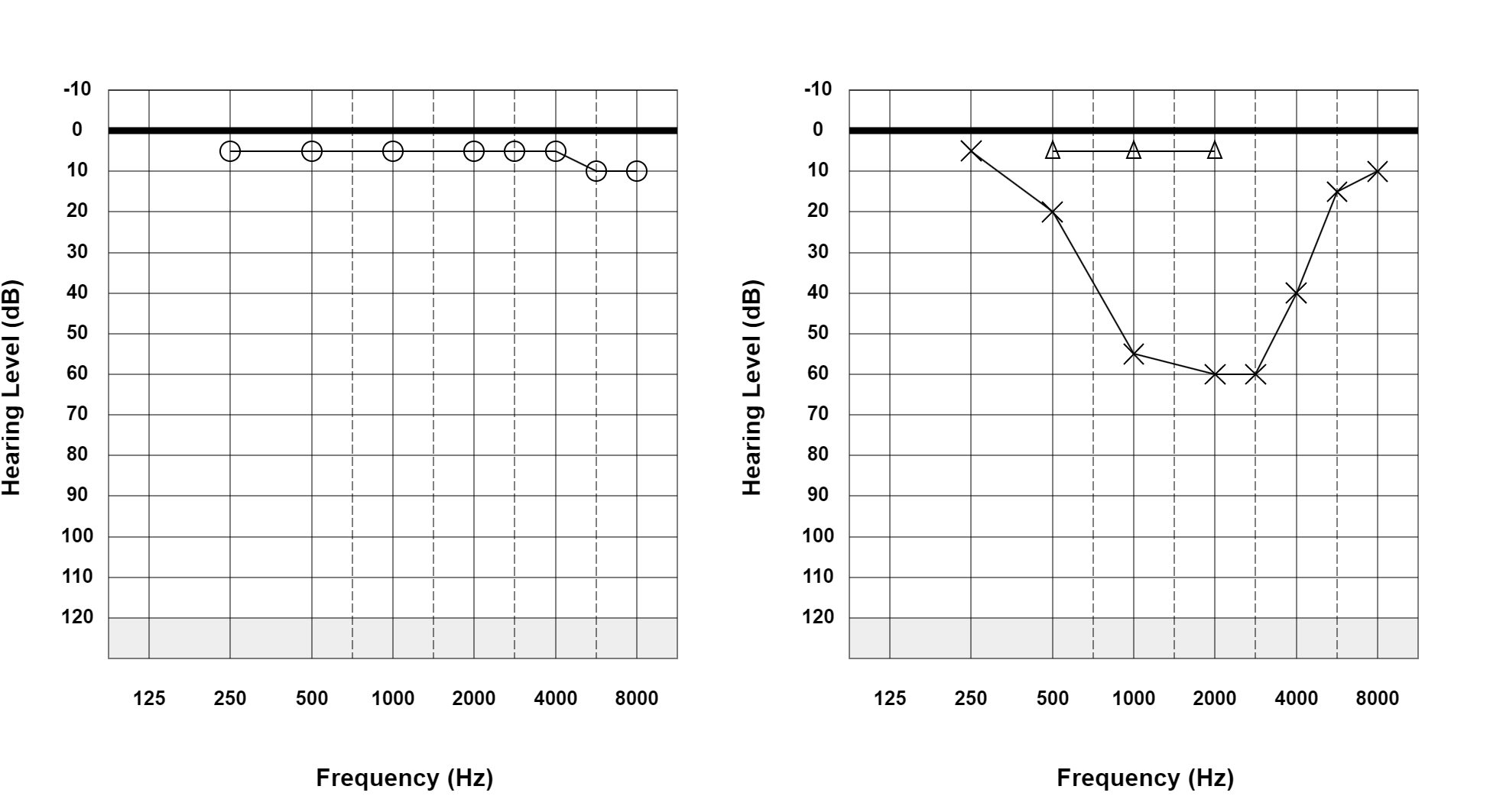 Case 22: supplied not-masked AC and BC audiogram