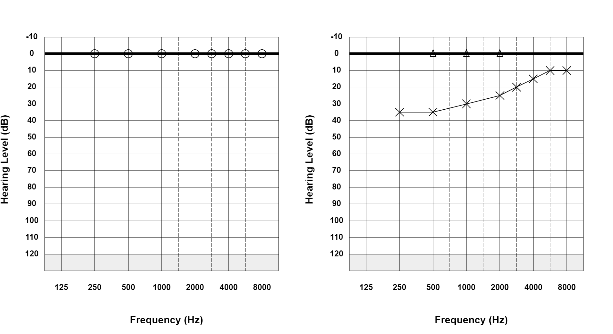Case 33: supplied not-masked AC and BC audiogram